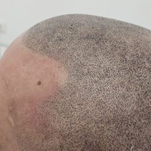 tricopigmentazione-densità-2